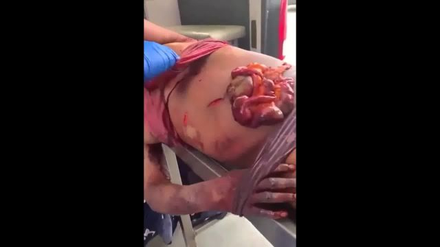 A Woman Goes To The Hospital With Her Guts Out And Horrific Cut Wounds